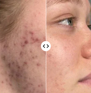 Spuogai (Acne)